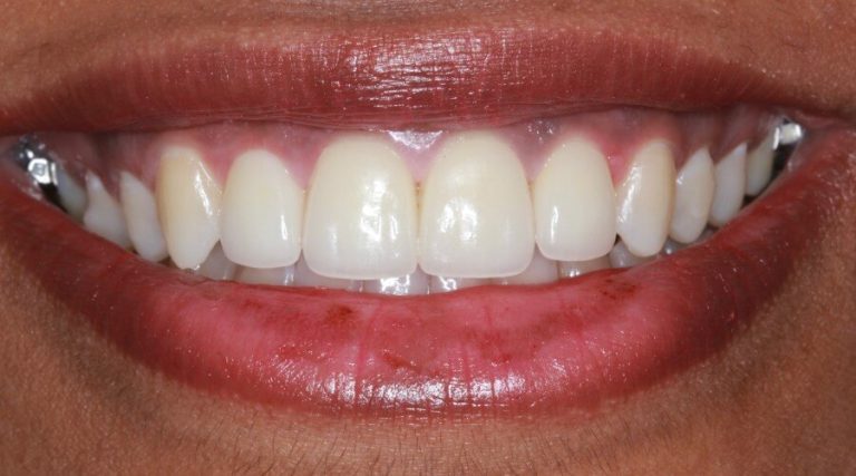 Smile Gallery - Merrifield Smiles